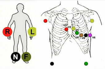 ECG